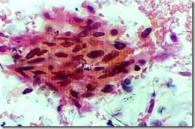 abnormal_carcinoma_cell