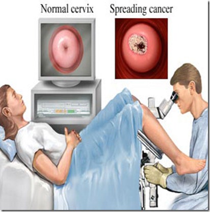coloscopy