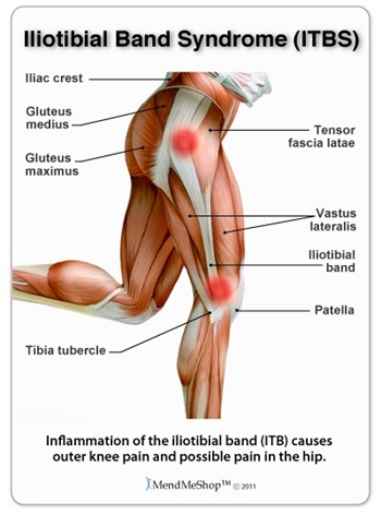 Iliotibial Band Syndrome (ITBS), liac crest, Gluteus medius, Tensor fascia latae, Gluteus maximus,Vastus lateralis, Iliotibial band, Tibia tubercle, Patella, Inflammation of the iliotibial band (ITB) causes outer knee pain and possible pain in the hip, MendMeShop TM  Â©2011